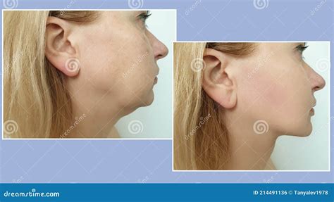 Woman Double Chin Before And After Treatment Facelift Stock Photo