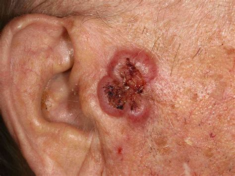 Tumor Skin Lesion