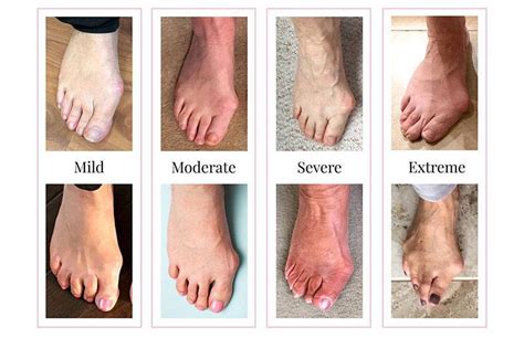 Seattle Bunion Treatment Surgical And Non Surgical Seattle Foot And