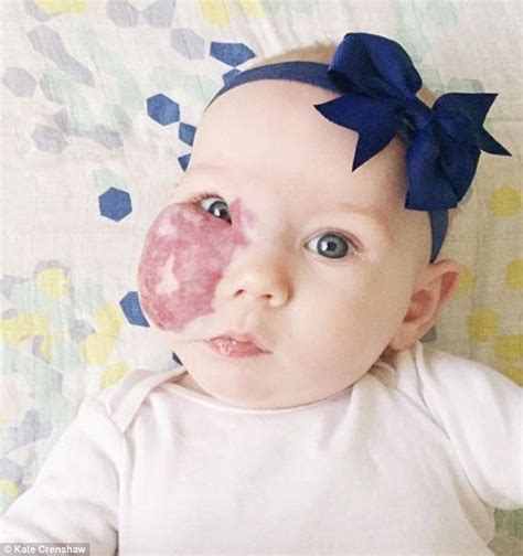 Unusual Red Birthmark Dat Will Surprise U And Here What Her Mum Says