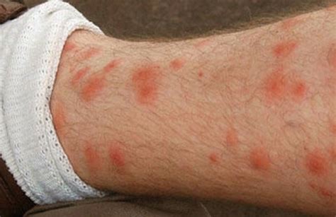 Red Spots On Legs Causes Small Raised Flat Or Itchy Skincarederm