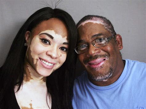 Inheriting A Rare Skin Condition And The Ability To Laugh About It Npr