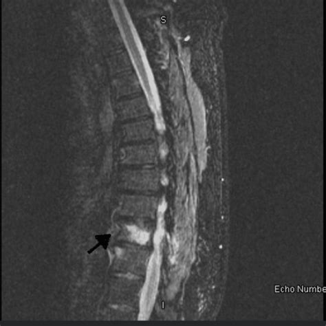Cureus A Case Report On The Rare Presentation Of The Primary Spinal