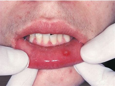 Sometimes, too, sores appear on the tongue or face. herpes simplex abreva Gallery
