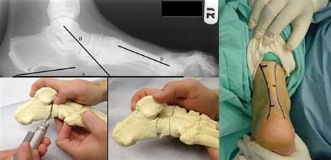A Pictorial Review Of Reconstructive Foot And Ankle Surgery Evaluation