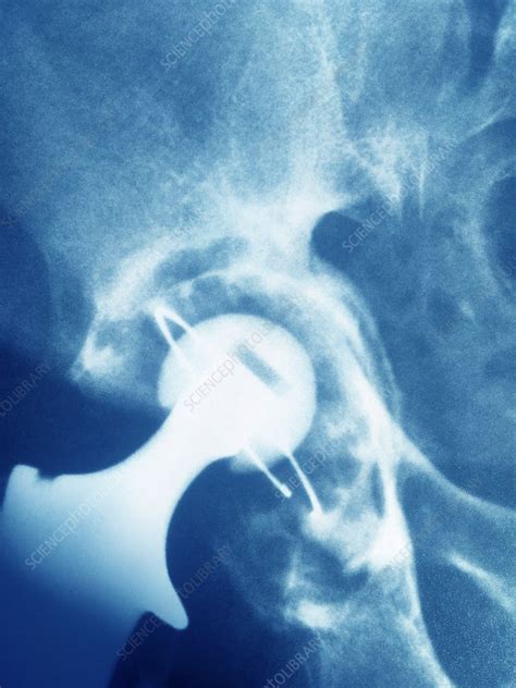 Damaged Hip Replacement X Ray Stock Image C0402183 Science