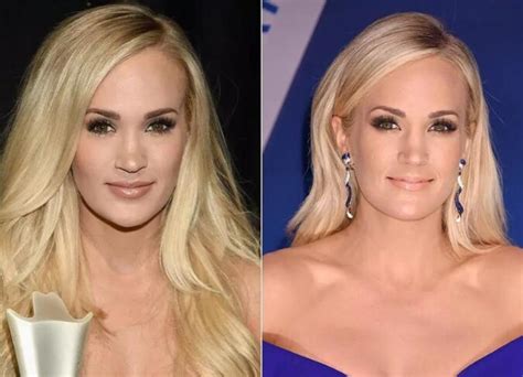 Carrie Underwood Plastic Surgery Did She Get Lip Surgery