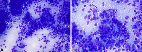A Touch Imprint Cytology Revealing Colon Adenocarcinoma In A Patient
