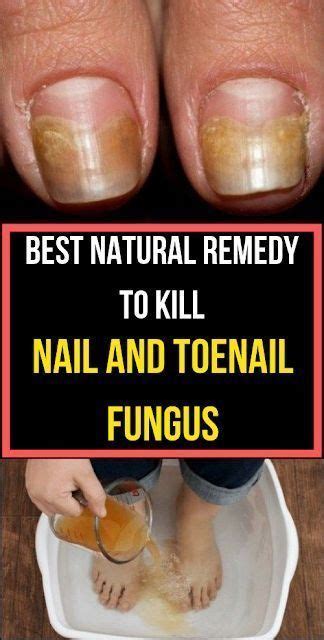 Best Natural Remedy To Kill Nail And Toenail Fungus Natural Healing