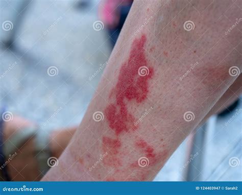 Leukocytoclastic Vasculitis An Inflammatory Reaction In The Blood