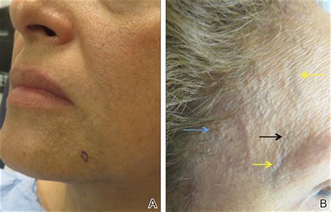 Frontal Fibrosing Alopecia Cutaneous Associations In Women With Skin