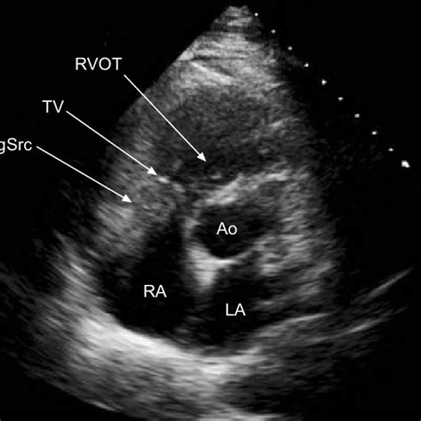 Trans Thoracic Echocardiogram Parasternal Short Axis Window At The
