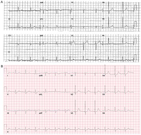 A The Patients 12 Lead Ecg With Third Degree Atrioventricular Av