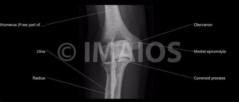 Elbow Radiographs Anterior Posterior View Lateral Epicondyle