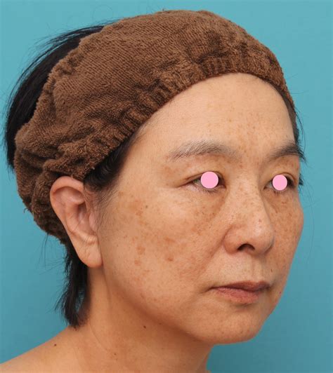 ミディアムフェイスリフトで頬のたるみをリフトアップさせた50代後半女性の症例写真です。 美容整形高須クリニック 高須 幹弥 オフィシャルブログ