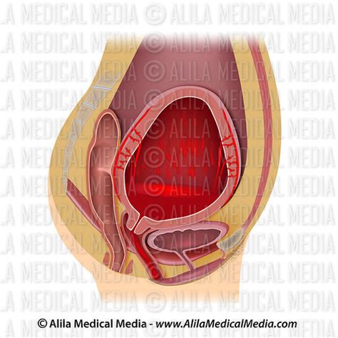 Alila Medical Media Uterine Atony Medical Illustration