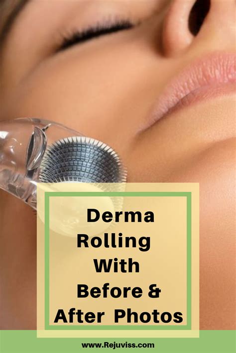 Is Derma Rolling Worth It See These Pictures And You Ll KNOW Why You