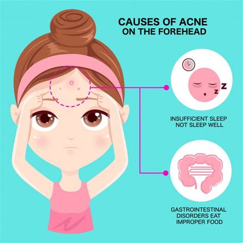 Causes Of Acne On The Forehead Acne Causes Forehead Acne Cause