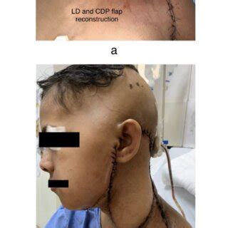 A B Latissimus Dorsi Myocutaneous Flap And Cervico Deltopectoral Flap