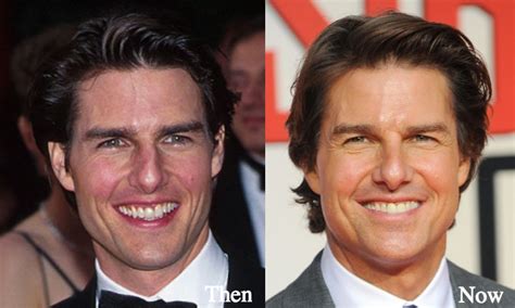 Tom Cruise Plastic Surgery Before And After