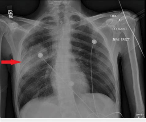 Chest X Ray On Admission Demonstrating A Right Middle Lobe Infiltrate