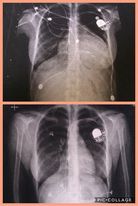 Before And After Picture Of 2 Liters Of Fluid Around The Heart Of 21