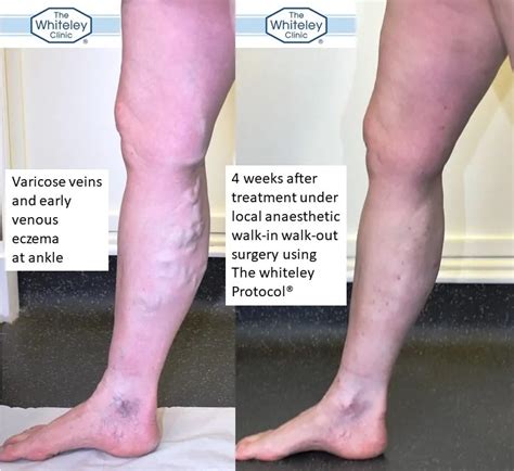 Walk In Walk Out Varicose Vein Surgery The Whiteley Clinic