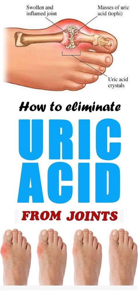 How To Eliminate Uric Acid From Joints