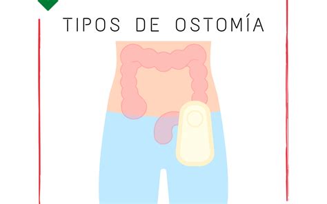 Ostomía tipos de colostomía y dieta Nutrygente