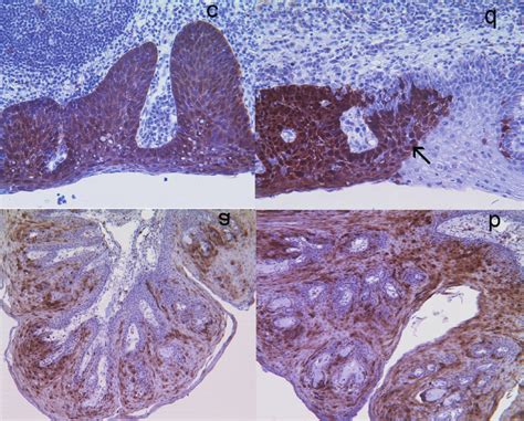 Representative Examples Of P16 Ink 4a Immunohistochemical Staining