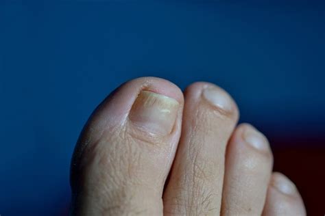 A Toe With Nail Psoriasis A Woman Has An Ingrown Toenail Short Cutted