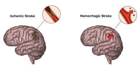 Types Of Strokes Cerebral Amyloid Angiopathy Caa
