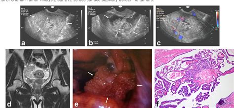 Figure 1 From Ovarian Serous Surface Papillary Borderline Tumor