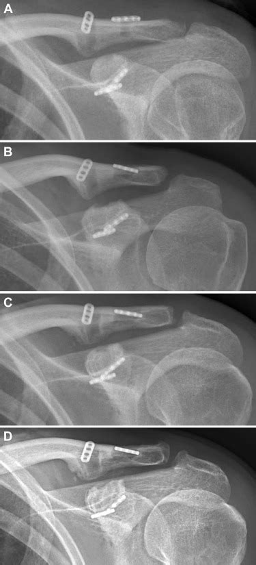 Truly Anatomic Coracoclavicular Ligament Reconstruction With 2
