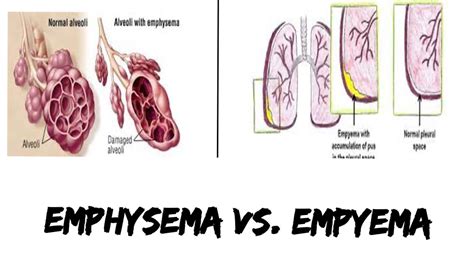 Emphysema Vs Empyema Youtube