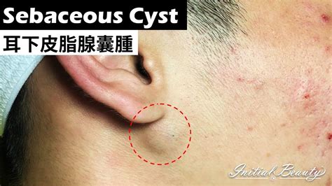 耳下皮脂腺囊腫 Sebaceous Cyst Under Ear Taiwan Tainan台南清粉刺最乾淨 Youtube