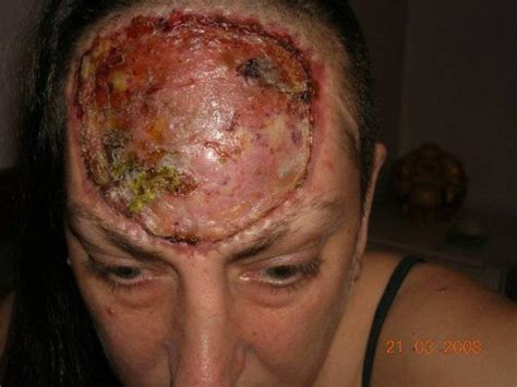 Pip Caliskan Woman Has Forehead Removed To Beat Dfsp Cancer Metro News