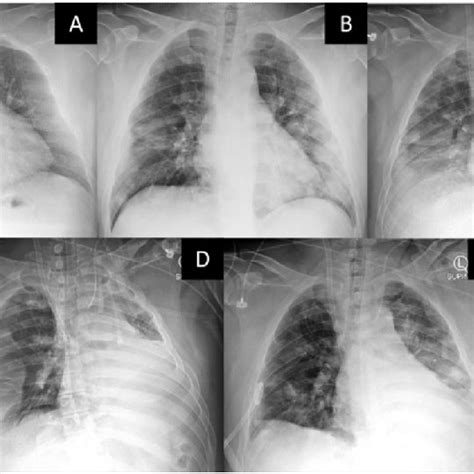 Serial Portable Chest Radiographs Of The Patient A Hospital Day 1