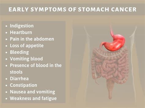 What Are The Early Symptoms Of Stomach Cancer Cancerwalls