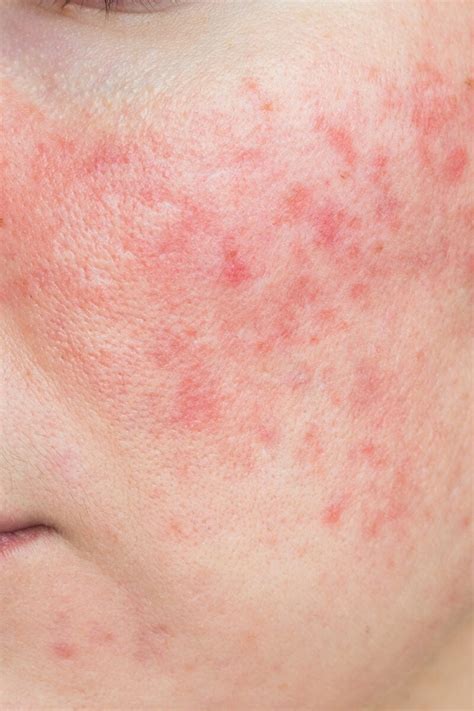 What To Know About Papulopustular Rosacea