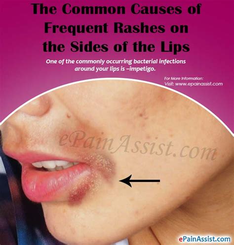 Rash On Lips Treatment