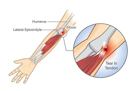 Tennis elbow is a repetitive strain injury in the forearm. Tennis elbow treatment often worsens injury - The San ...