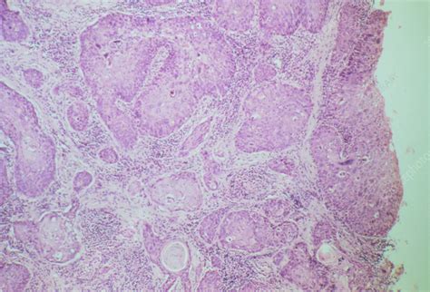 Lm Of Squamous Cell Carcinoma Of The Larynx Stock Image M1320546