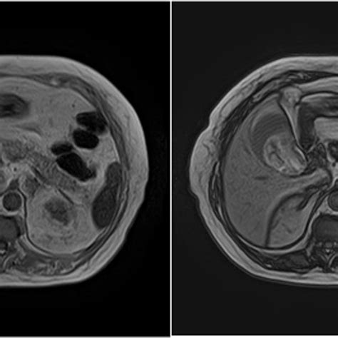 T1 Mri Images Showing A Heterogenic In Phase And Out Of Phase