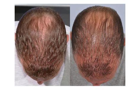 Finasteride works best at preventing further hair loss. Finasteride 5mg Hair Loss