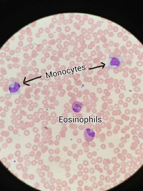 Wbc Normal Range Child Male Female Significance White Blood Cell