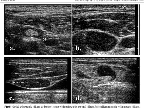 Figure 9 From Ultrasonography Of Superficial Lymph Nodes Benign Vs