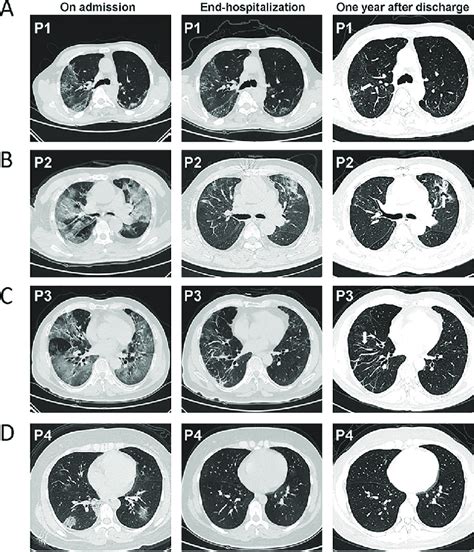 Chest Computed Tomography Scan Of Four Patients Across Three Time