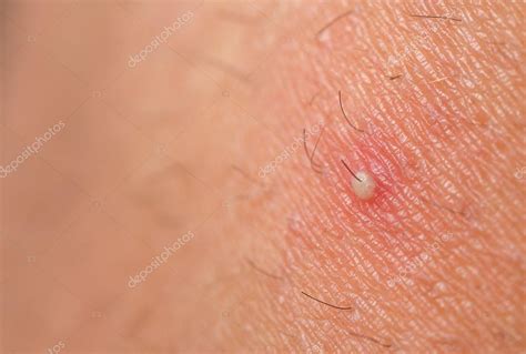 Closeup Of Ingrown Hair ⬇ Stock Photo Image By © Saaaaa 20216429