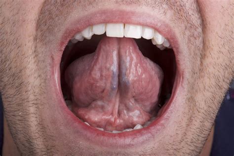 Hpv Under Tongue Tot Ce Trebuie Sa Stii Despre Hpv Simptome Tratament The Best Porn Website